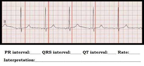 Image result for Pacemaker Programming
