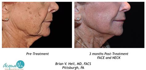 Image result for Profound Face Procedure