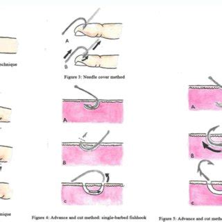 Image result for String Pull Method Fish Hook Removal