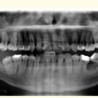 Image result for Post Extraction Recovery