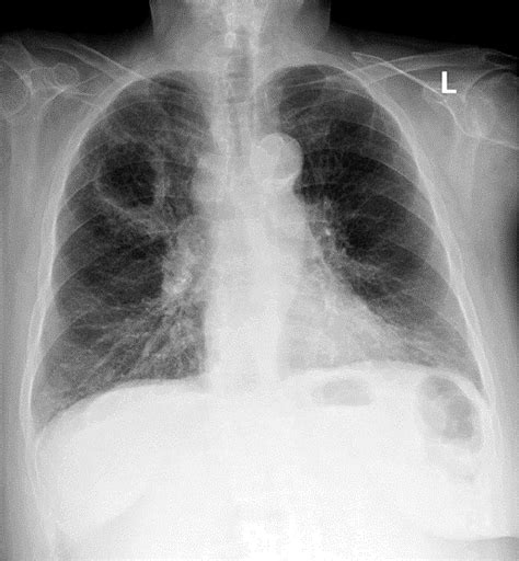 Consider the ‘Hole’ Differential: Pulmonary Malignancy Presenting as a Cavitary Lesion - The ...