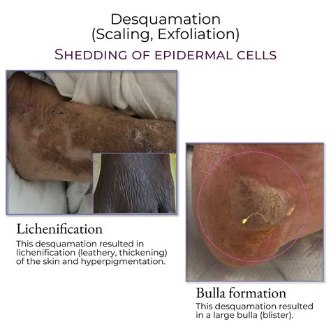 Clinical Medicine: Common Skin Lesions | ditki medical & biological ...