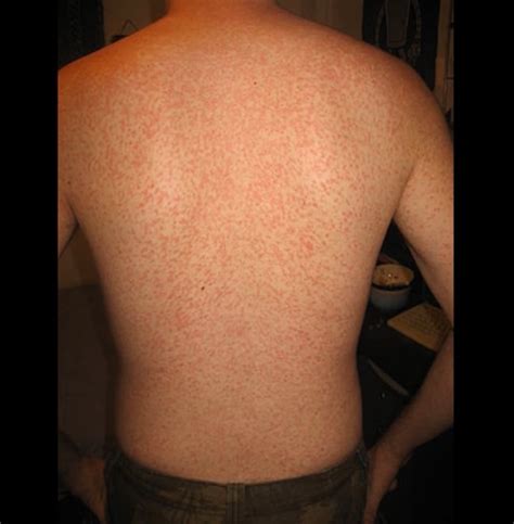 What does HIV rash looks like? - STD Testing Near Me