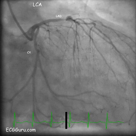 Circumflex Artery