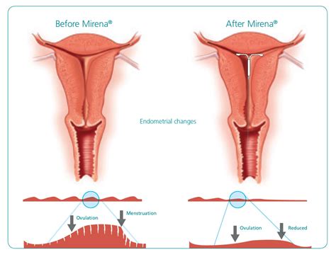 Mirena® Coil | 52mg Levonorgestrel Intrauterine System|Bayer