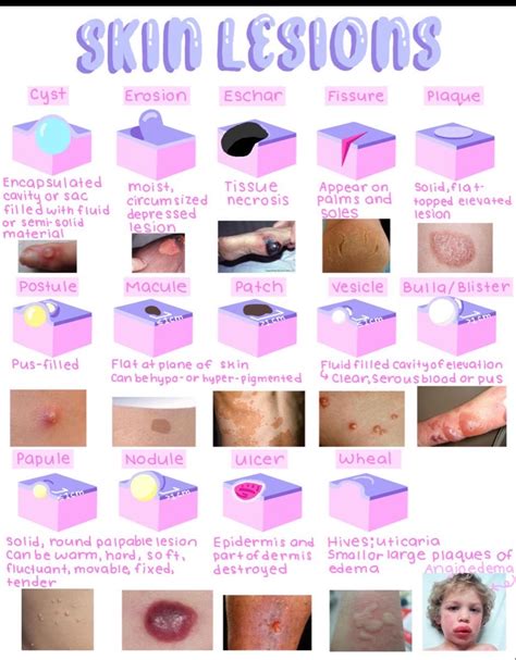 Moisture associated skin damage know your type – Artofit