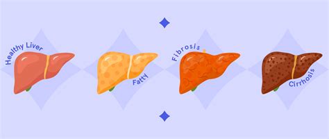 Liver Cirrhosis: Questions, Facts & Medical and Surgical Management