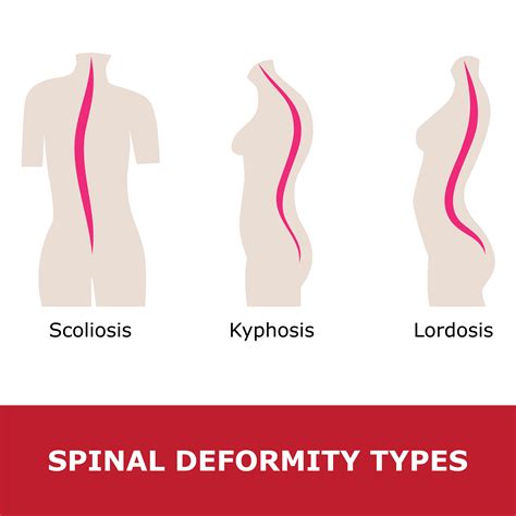 What Is Lordosis Lumbar Cervical Swayback Or Curved Spine Lordosis