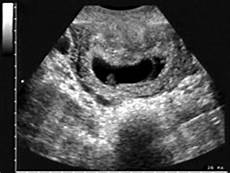 gestazionale senza embrione cause gestazionale senza embrione cause