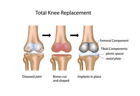 Knee Replacement Recovery 的图像结果