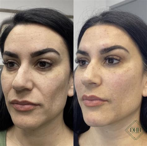 PRP/PRF Injections for Skin Rejuvenation | Scottsdale
