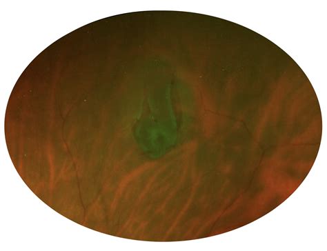 Retinal Tears – Blue Coast Retina