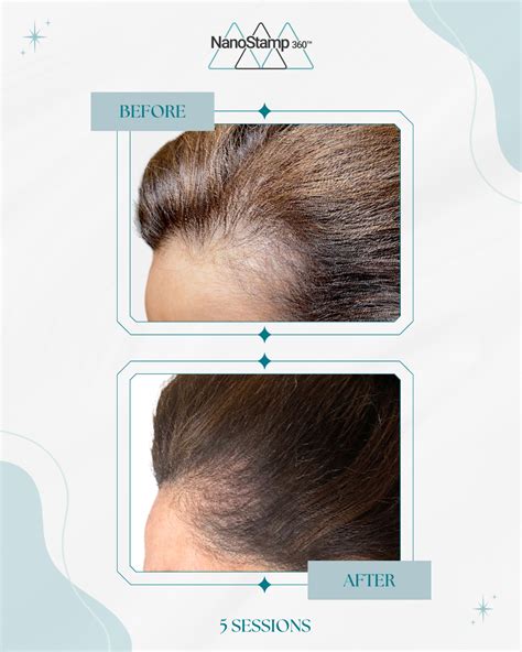 Microneedling Hair Edges at James Aviles blog