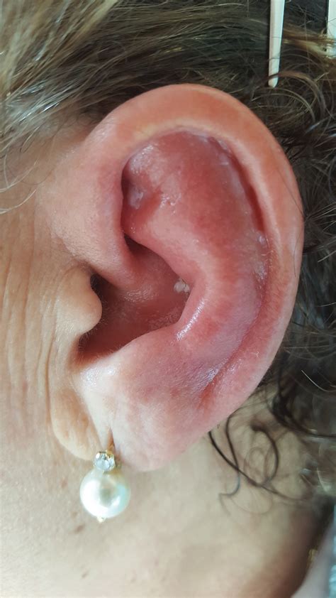Ear Pain Outer Edge