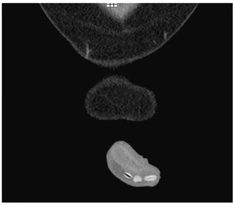 A 30-year-old man injected 6 kidney stones in his genitals for sexual ...