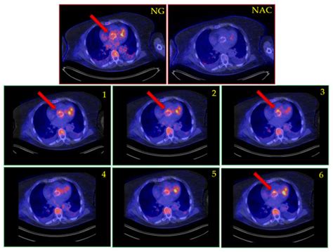 Improved [18F]FDG PET/CT Diagnostic Accuracy for Infective Endocarditis ...