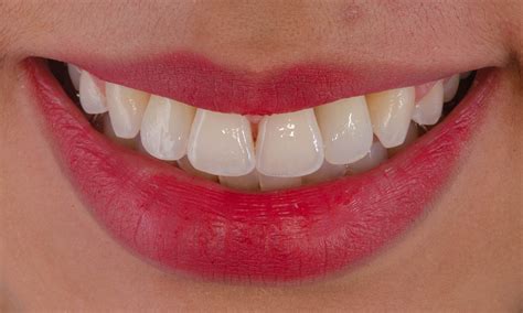 CEREC Dental Milling Machines | Dentsply Sirona India