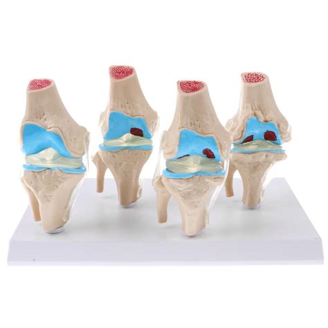 ⚡️Buy Maxbell Human Pathological Knee Joint Health Lesion Comparison ...