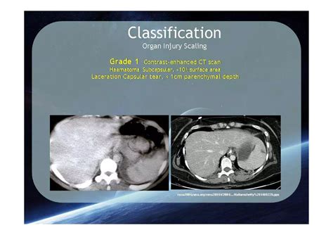Spleen Trauma Classification | PDF