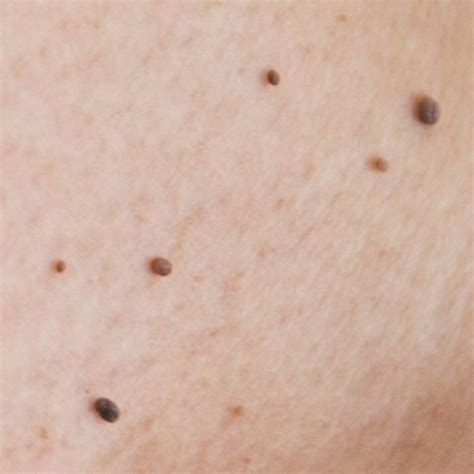 Why Am I Getting Skin Tags? Causes & Removal in London