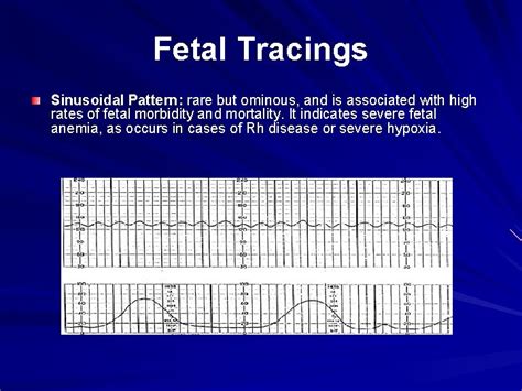 Fetal HR Tracings Fetal Heart Rate FHR is
