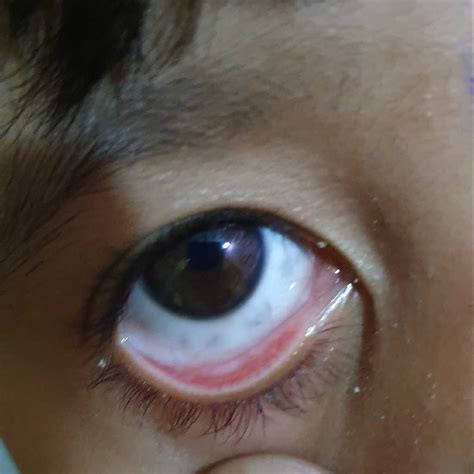 Black Spot In Eye Ball