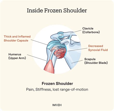Everything You Need To Know About Frozen Shoulder