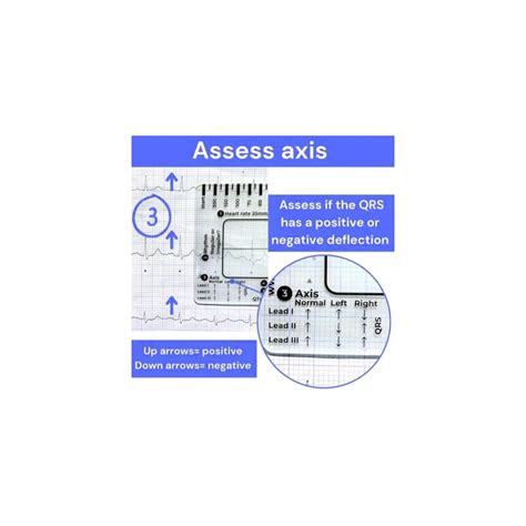Witpiny ECG 7 Step Ruler for ECG/EKG Interpretation - India | Ubuy