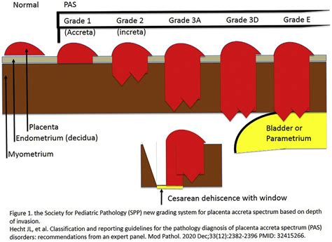 The new pathology classification for placenta accreta spectrum is well associated with clinical ...