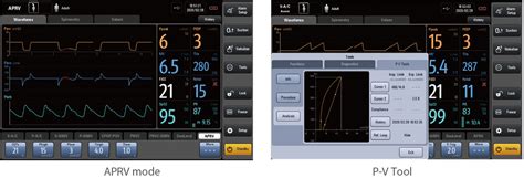 SV300 Ventilator: A Warrior in the Battle against COVID-19 - Mindray India