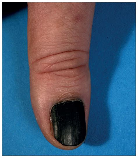 Melanoma Line On Nail at Irene Rodriguez blog