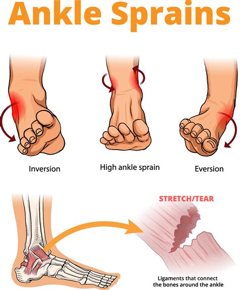 illustration of ankle sprains types 33238887 Vector Art at Vecteezy