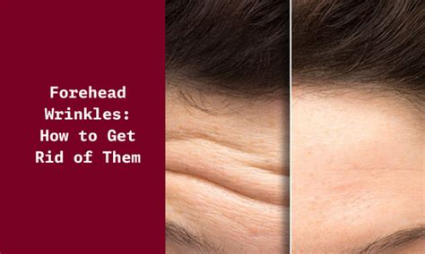 How to Get Rid of Forehead Wrinkles - Causes & Types of Forehead ...