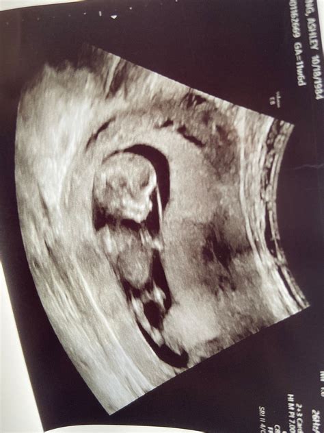 Nub or penis? | BabyCenter