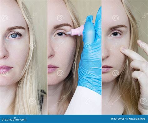 Before and after Eye Drops To Examine the Fundus, Pupil Dilation. a ...