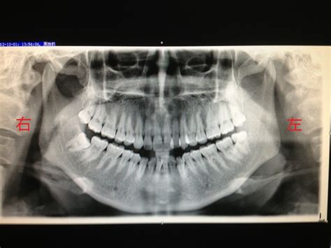 智齿冠周炎，已经拍了牙片，请朋友们瞧瞧，这种情况可以不拔牙吗？_百度知道