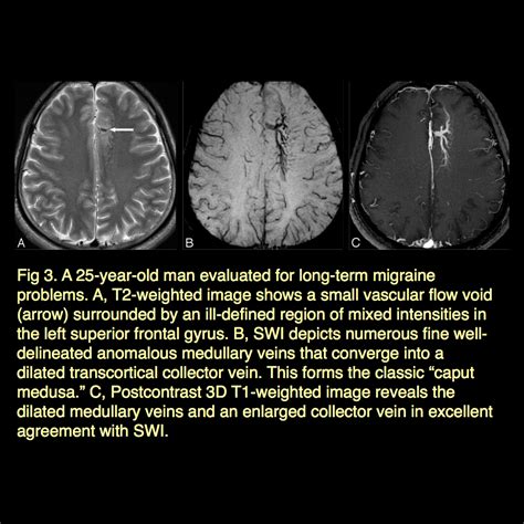 Susceptibility Weighted Imaging