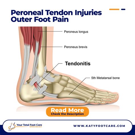 Peroneal Tendon Injuries – Outer Foot Pain | Katy Foot Care