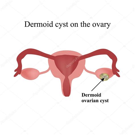 Dermoid cyst on the ovary. Ovary. Infographics. Vector illustration on isolated background Stock ...