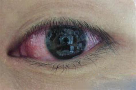 过敏性结膜炎眼角早期症状图片_有来医生