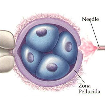 Laser Assisted Hatching - Fertility Treatments at Southern Gem