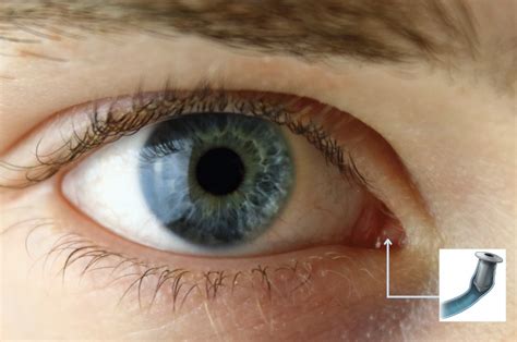 Punctal Plugs – Dry Eye Central Coast