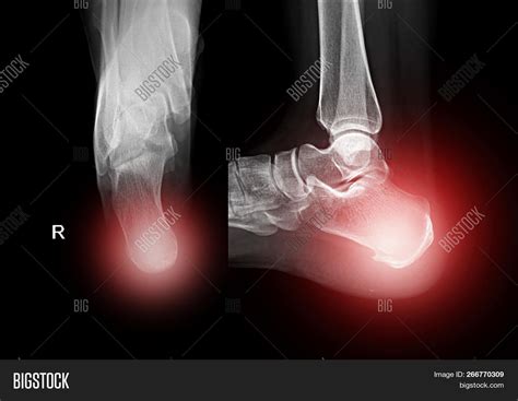 X-ray Normal Human Image & Photo (Free Trial) | Bigstock