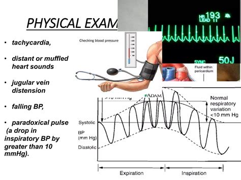 Cardiac tamponade | PPTX | Heart and Cardiovascular Diseases | Diseases ...