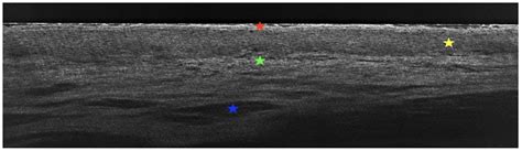 Diagnostic Difficulties of Erosive Lichen Planus in a Pediatric Patient
