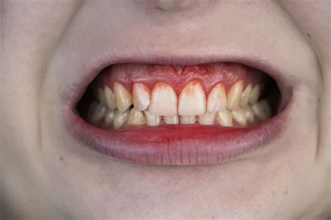 别不当回事！牙龈出血严重会掉牙，还可能是重大疾病的信号！_腾讯新闻