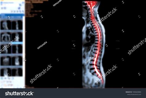 Spinal Cord Compression 的图像结果