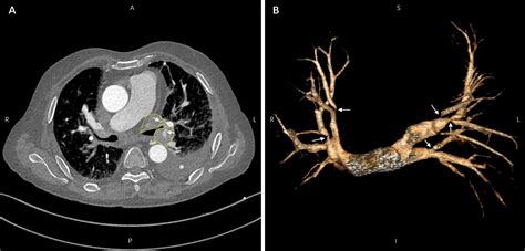 Catheter-based Endovascular Angioplasty for Fibrosing Mediastinitis ...