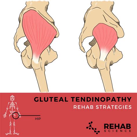What Is Gluteal Tendinopathy