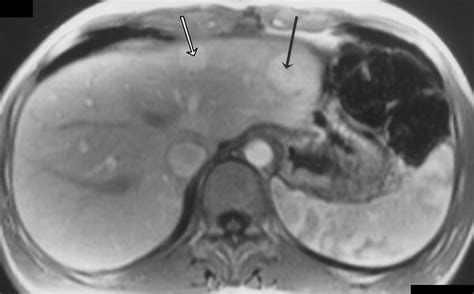 Atypical Focal Nodular Hyperplasia of the Liver: Imaging Features of ...